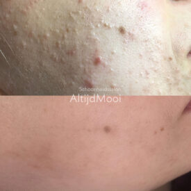 acne huid