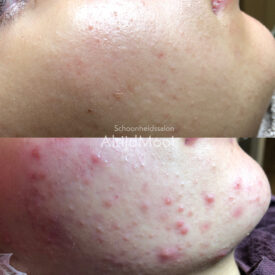 jonge acne huid zuiverende behandeling
